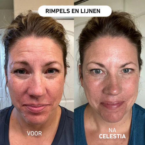 Micro-Infusie Anti-Verouderings Kit™